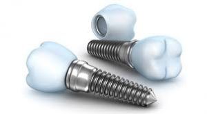 innovacion-implantes-dentales-3-1