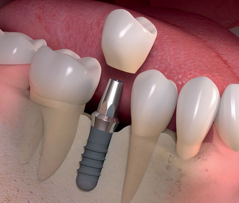 Revolución en los implantes dentales